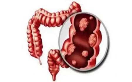 علامات تحذيرية لسرطان القولون.. تظهر أثناء تناول الطعام