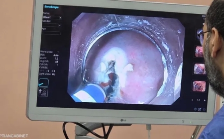 لعلاج القولون.. الذكاء الاصطناعي يقتحم غرف المناظير في مصر