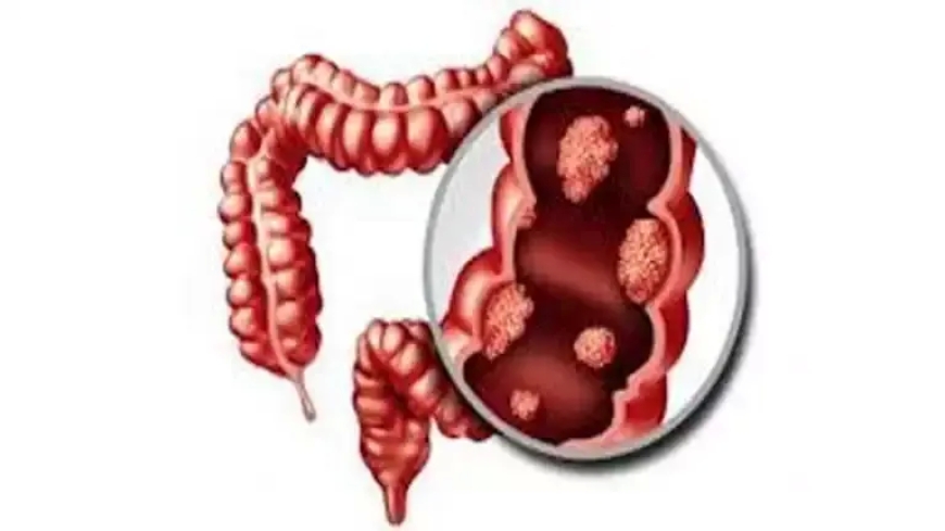 علامات تحذيرية لسرطان القولون.. تظهر أثناء تناول الطعام