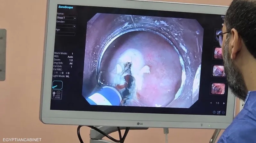 لعلاج القولون.. الذكاء الاصطناعي يقتحم غرف المناظير في مصر