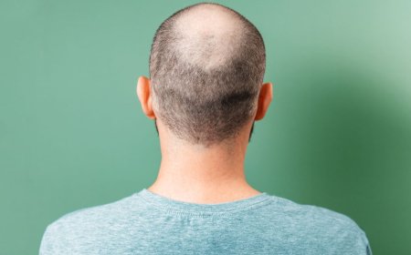 نتائج واعدة لعقار جديد لعلاج الصلع الوراثي